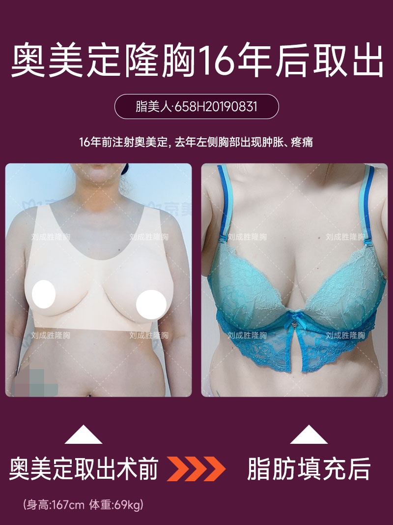 在成都哪里可以安全取出奥美定？医疗机构推荐与注意事项